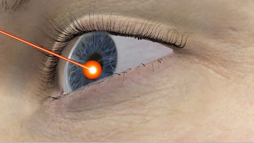 أبحاث لاستخدام الليزر لتغيير لون عينيك