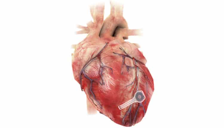 تطوير أول جهاز لاسلكى فى العالم لتنظيم ضربات القلب بدون بطارية