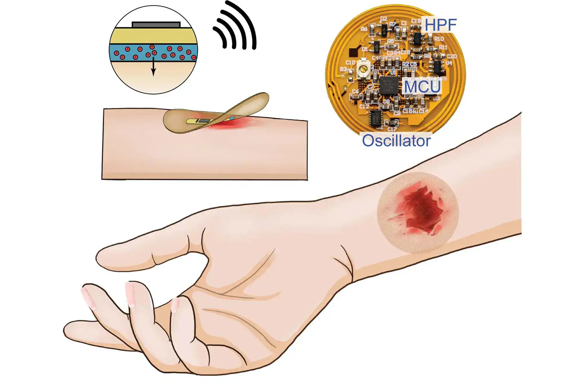 ابتكار ضمادة ذكية تستخدم الكهرباء تسرع التعافي من الجروح