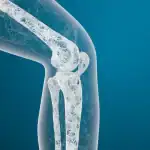 الفقاعات النانوية.. طريقة جديدة لعلاج هشاشة العظام