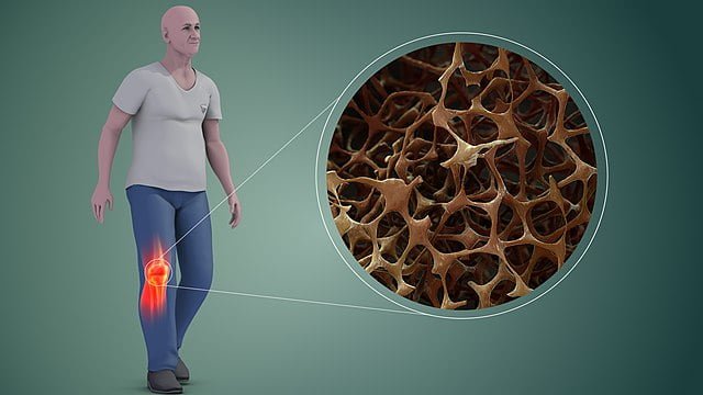 الفقاعات النانوية.. طريقة جديدة لعلاج هشاشة العظام