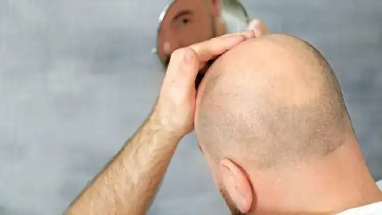 بشرى للصُلع.. اختراق جين يحفز نمو الشعر