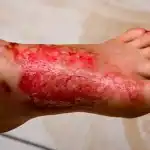 علاج الحروق