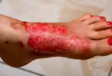 علاج الحروق